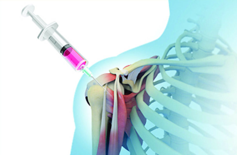 Bone Marrow Concentrate Injection For Cartilage Defects - Shashidhar ...